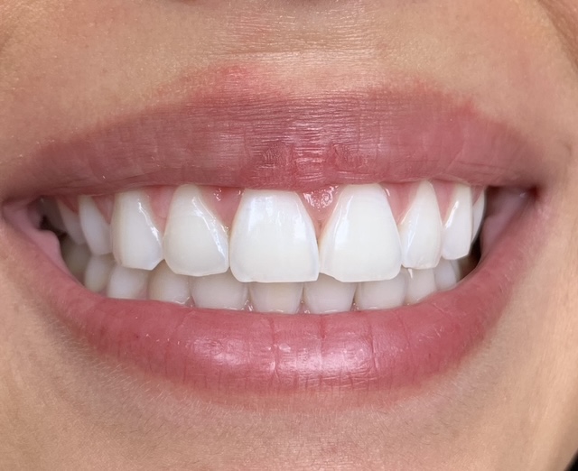 blanchiment-dentaire-cm-beauty